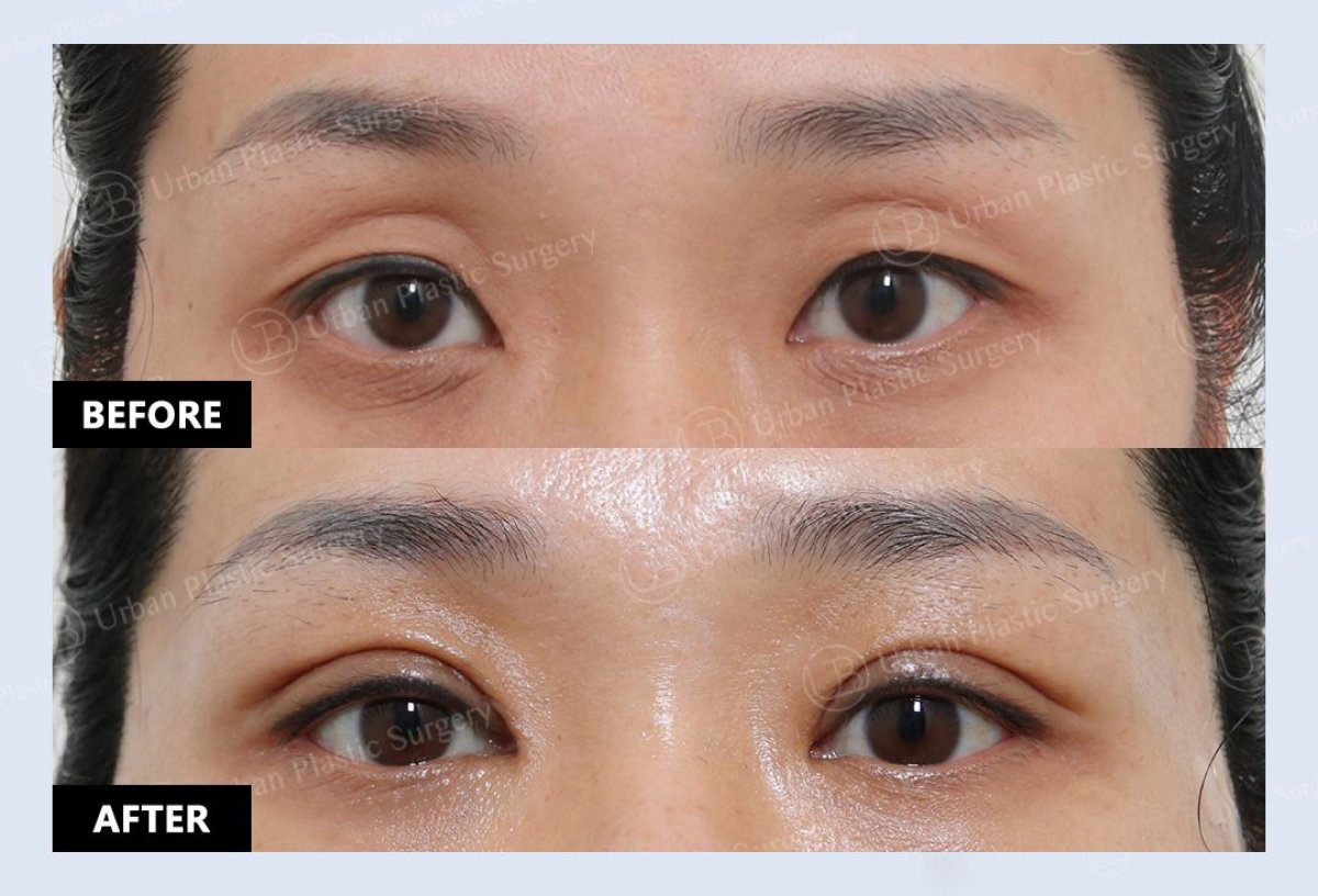 Resultados de blefaroplastia antes y después en URBAN Plastic Surgery, corrección de párpados