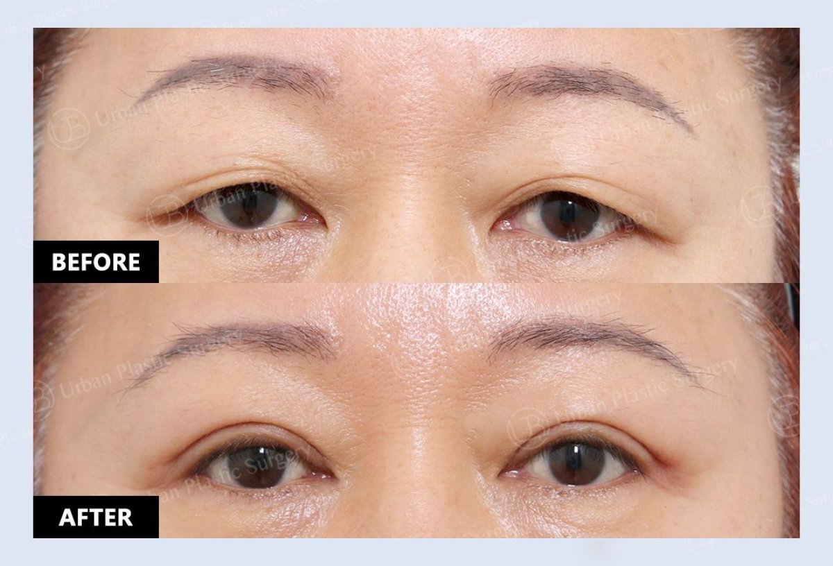 Resultados de blefaroplastia antes y después en URBAN Plastic Surgery, corrección de párpados