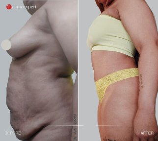 Premium 360 Degrees Tummy Tuck and Love Handles Liposuction All Included - photo 6