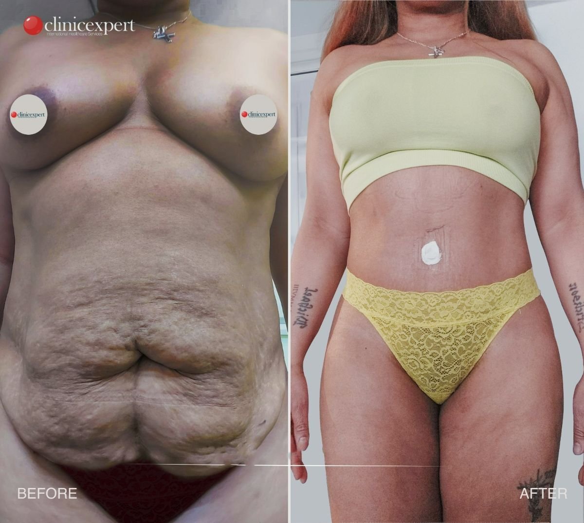 Before and after tummy tuck and liposuction results at CE International Hospital, flatter abdomen