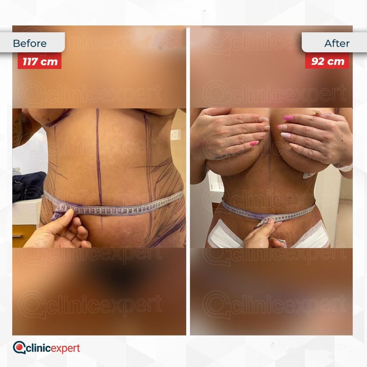 Resultados de abdominoplastia y liposucción antes y después en CE International Hospital, reducción de cintura