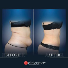 Premium 360 Degrees Tummy Tuck and Love Handles Liposuction All Included