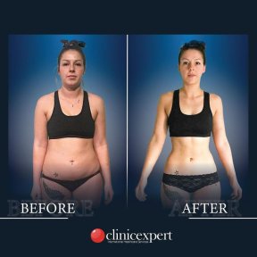Premium 360 Degrees Tummy Tuck and Love Handles Liposuction All Included - photo 5