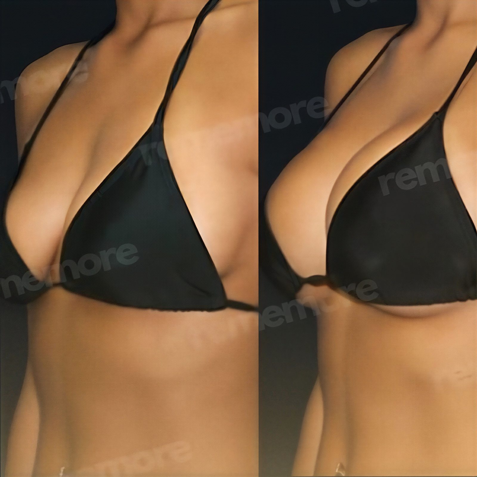 Resultados antes y después de aumento de senos con lipofilling en Memorial Bahçelievler Hospital