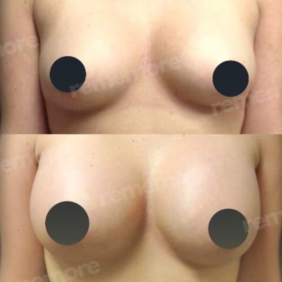 Résultats avant/après augmentation mammaire par lipofilling à Memorial Bahçelievler Hospital