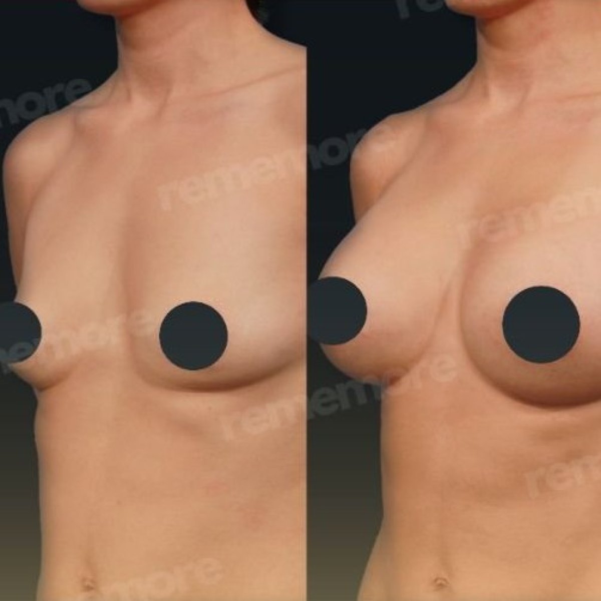 Résultat avant/après augmentation mammaire par lipofilling à Memorial Bahçelievler Hospital