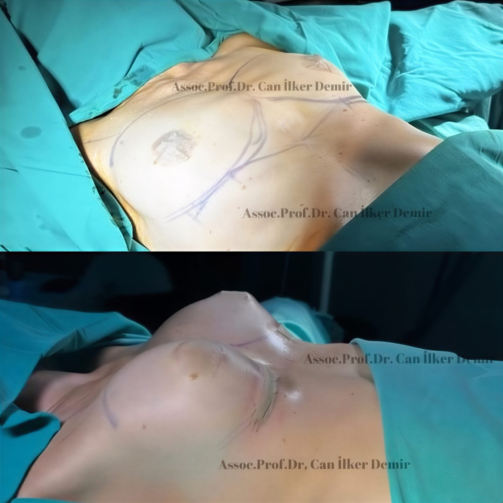 Resultado antes y después de aumento de senos con lipofilling en Memorial Bahçelievler Hospital