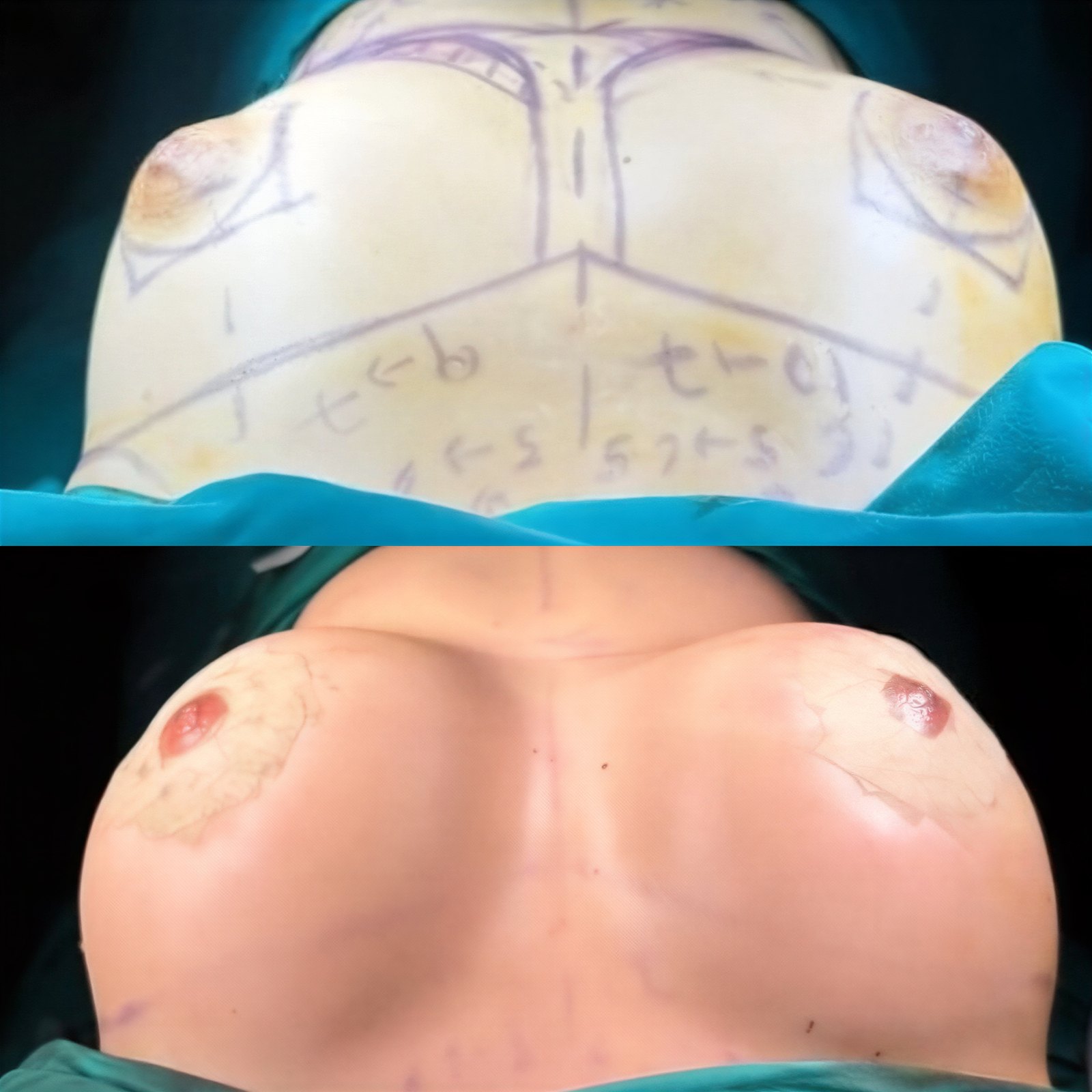 Resultados antes y después de aumento de senos con lipofilling en Memorial Bahçelievler Hospital