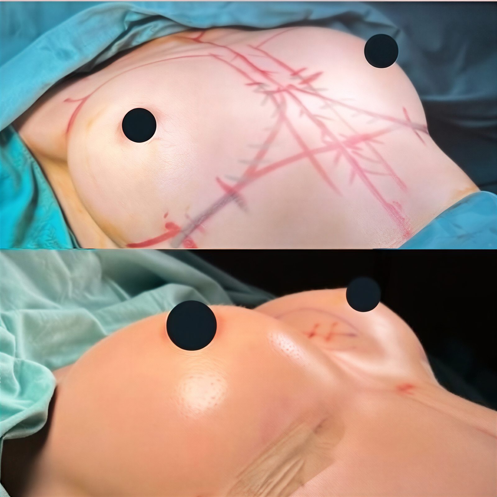 Resultados antes y después de aumento de senos con lipofilling en Memorial Bahçelievler Hospital