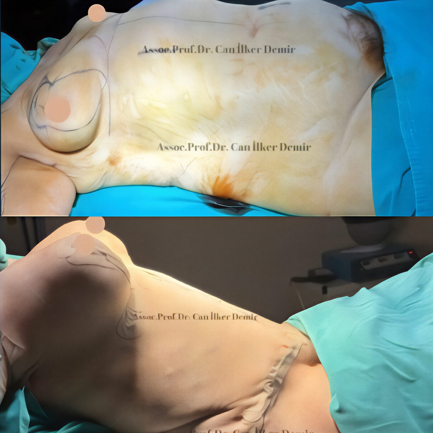 Resultados antes y después de mommy makeover en Memorial Bahçelievler Hospital, contorno corporal