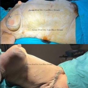 Standard Mommy makeover with Motiva® Ergonomix® breast implants All Included - photo 6