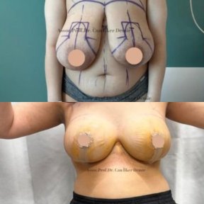 Standard Mommy makeover with Motiva® Ergonomix® breast implants All Included - photo 5