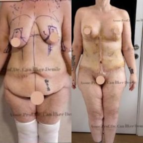 Standard Mommy makeover with Motiva® Ergonomix® breast implants All Included - photo 4