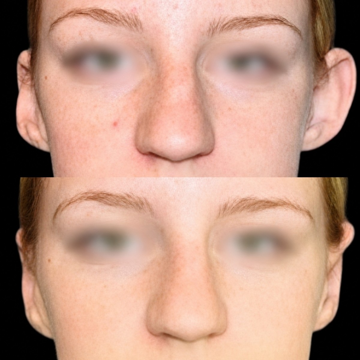 Before and after otoplasty results at Memorial Ataşehir Hospital, ear reshaping surgery