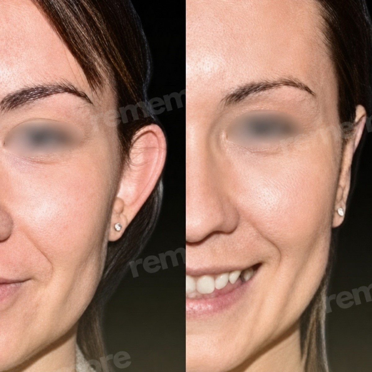 Resultados de otoplastia antes y después en Memorial Ataşehir Hospital, cirugía de orejas