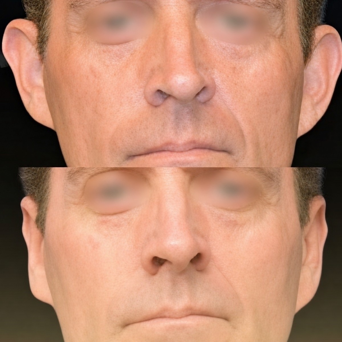 Resultados de otoplastia antes y después en Memorial Ataşehir Hospital, cirugía de orejas