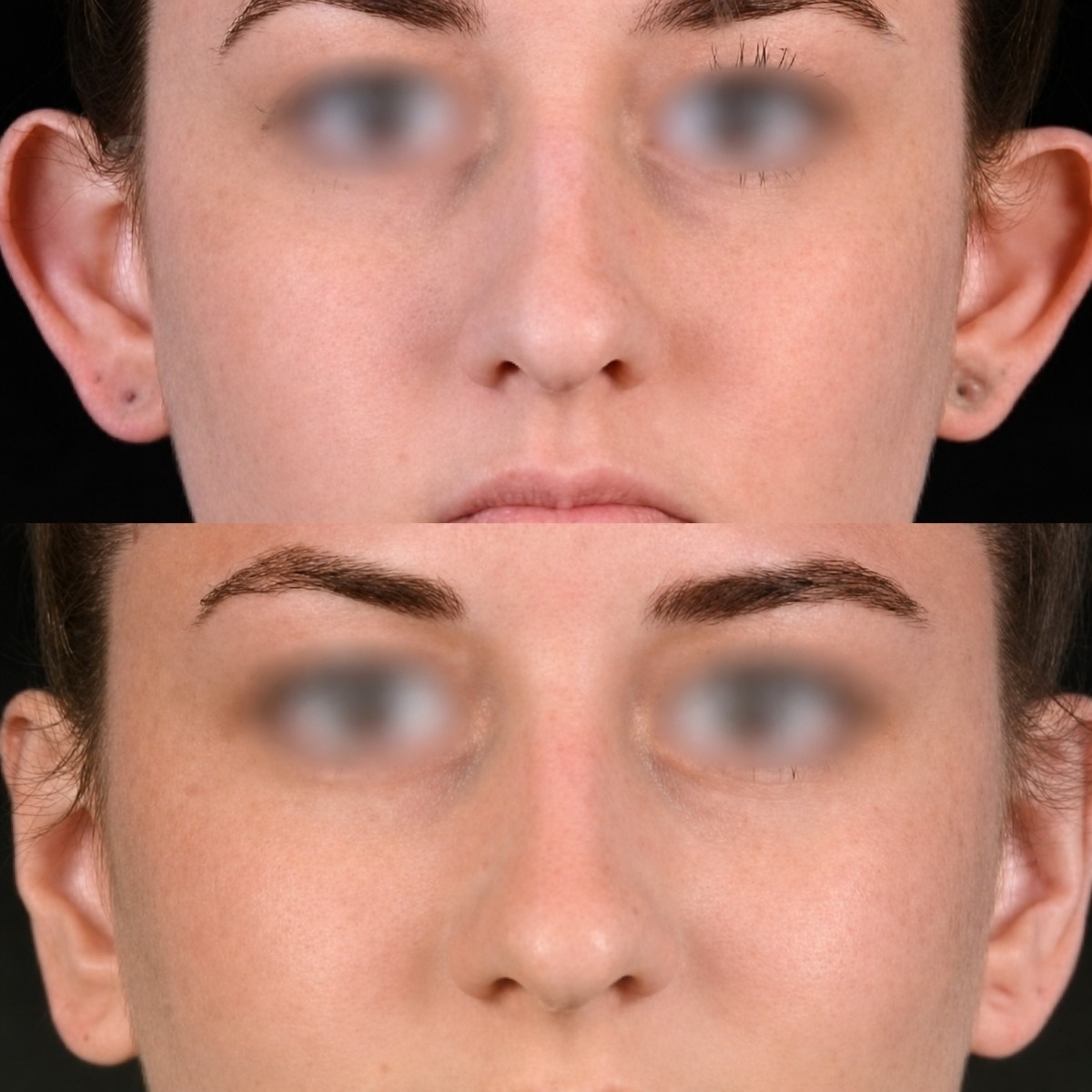 Before and after otoplasty results at Memorial Ataşehir Hospital, ear reshaping surgery