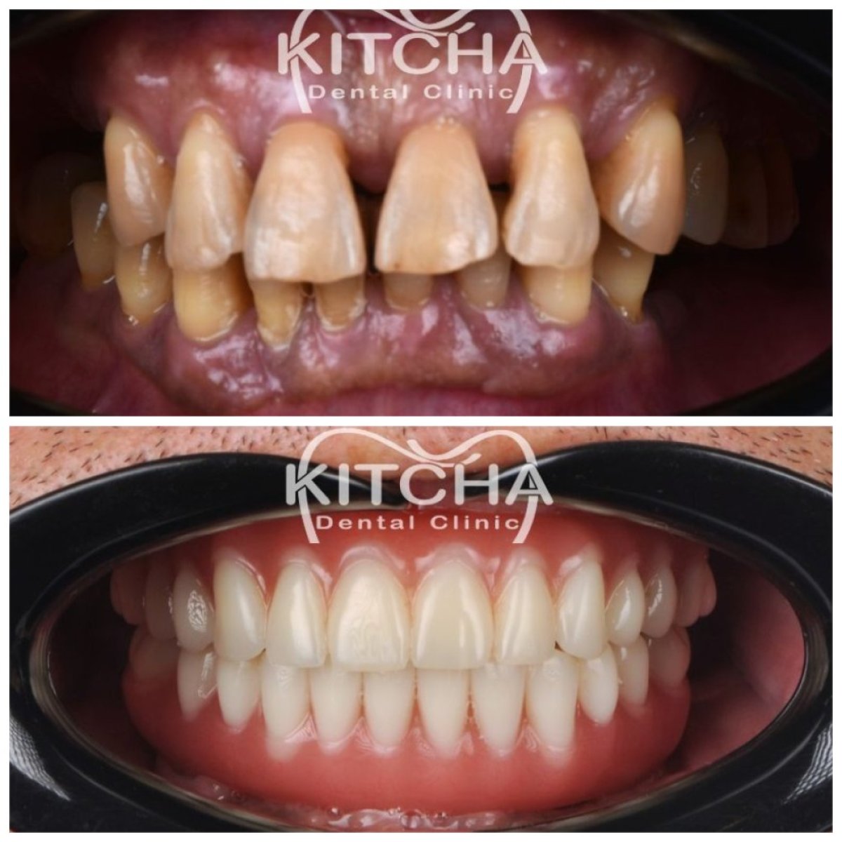 Resultado antes y después de implantes All-on-4 en Kitcha Dental Clinic, restauración total de sonrisa
