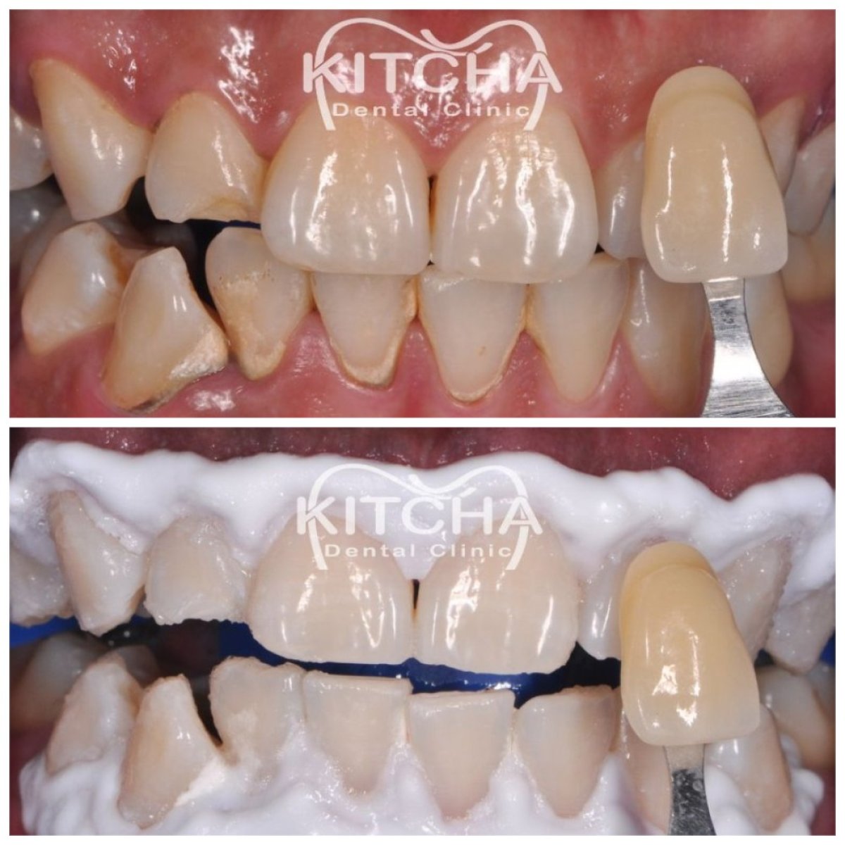 Résultats avant et après du blanchiment des dents à Kitcha Dental Clinic, dents plus blanches