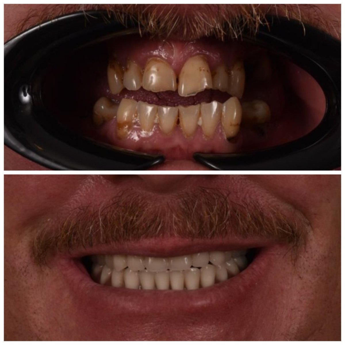 نتائج قبل وبعد تركيب تيجان الأسنان في عيادة Kitcha Dental Clinic، استعادة الابتسامة