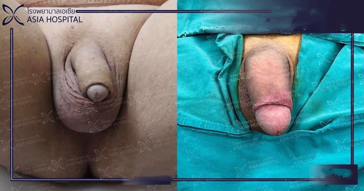 Before and after penis enlargement results at Asia Cosmetic Hospital, visible size improvement
