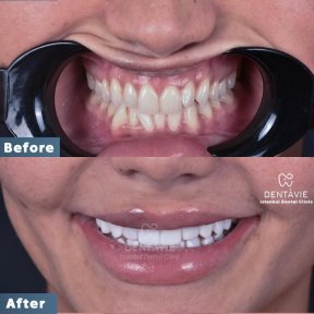 Hollywood Smile