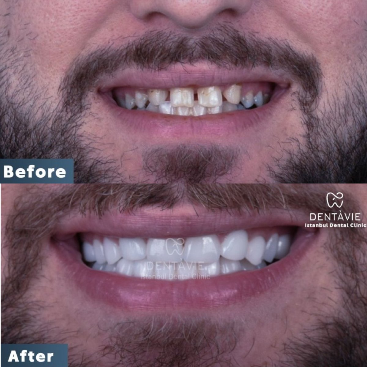 نتائج قبل وبعد ابتسامة هوليود في Dentavie Istanbul Dental Clinic، تحول الابتسامة