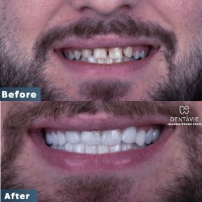 Hollywood Smile - photo 3