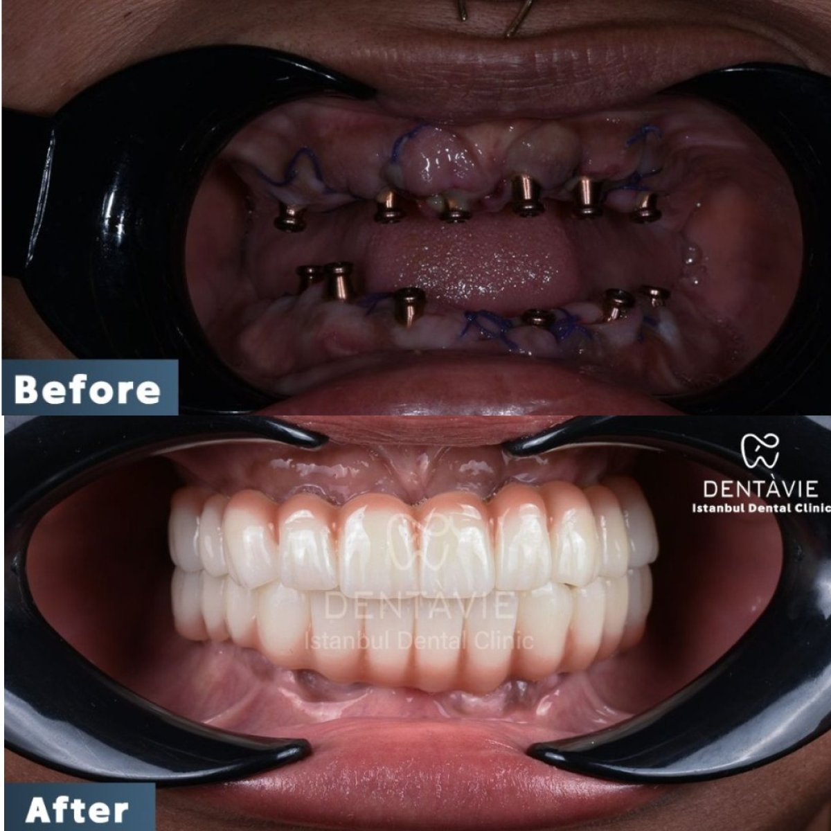 نتيجة قبل وبعد زراعة الأسنان All-on-6 في Dentavie Istanbul Dental Clinic، ابتسامة كاملة