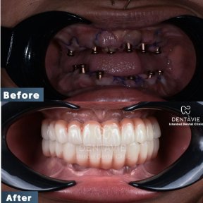 All-Inclusive All-on-6 Dental Implants