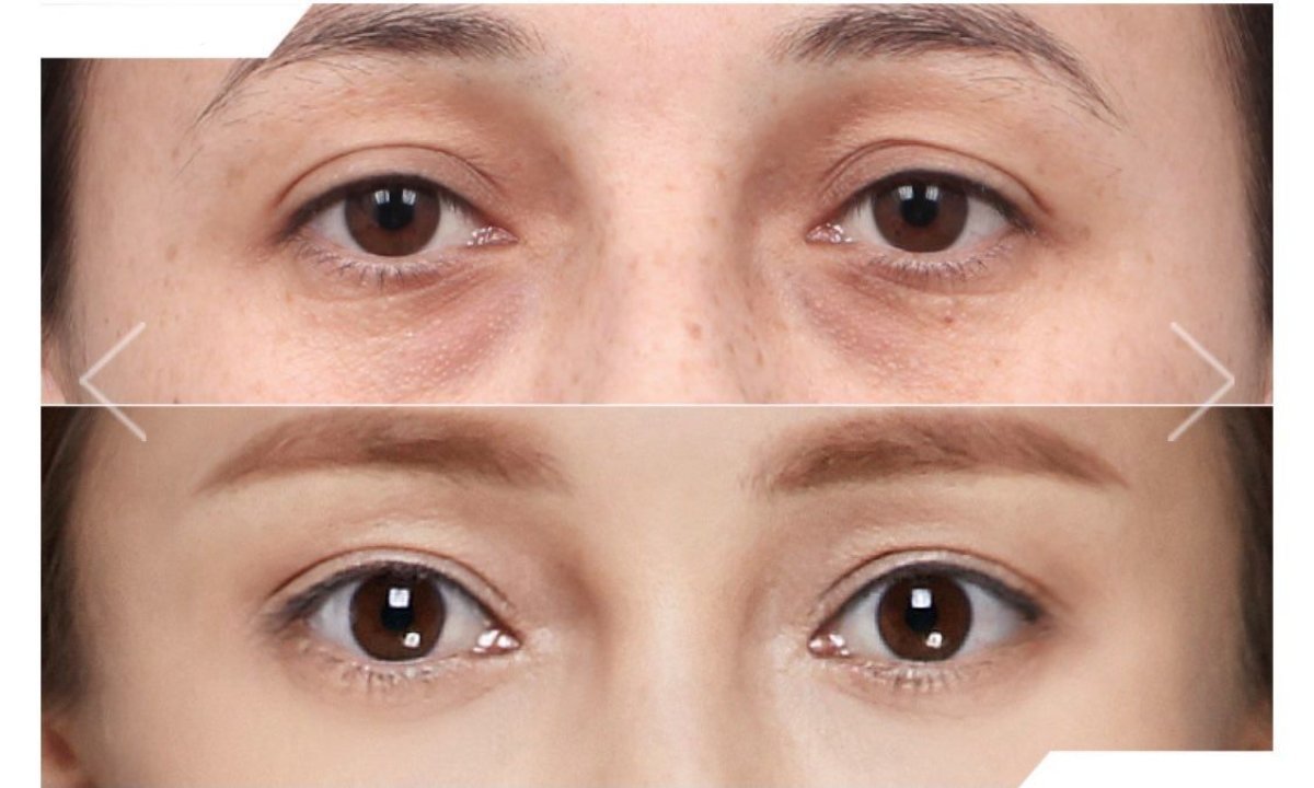Resultados de blefaroplastia antes y después en URBAN Plastic Surgery, corrección de párpados