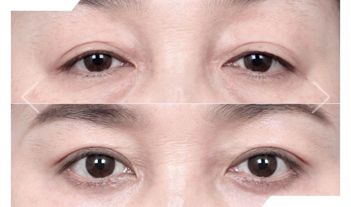 Before and after blepharoplasty results at URBAN Plastic Surgery, eyelid correction procedure