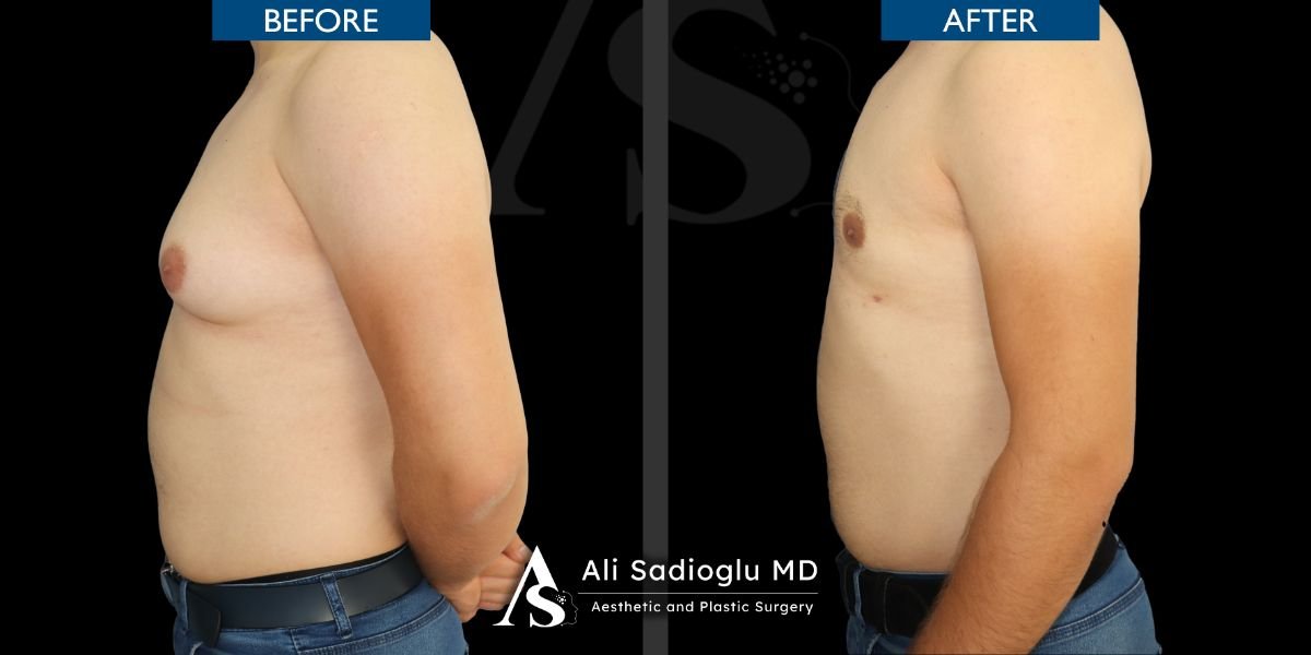نتائج شفط الدهون 360 قبل وبعد في عيادة Dr. Safa Manav، تحسين شكل الجسم