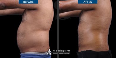 360° Liposuction by European Board-Certified Surgeon — 7 Nights & VIP Transfer - photo 4