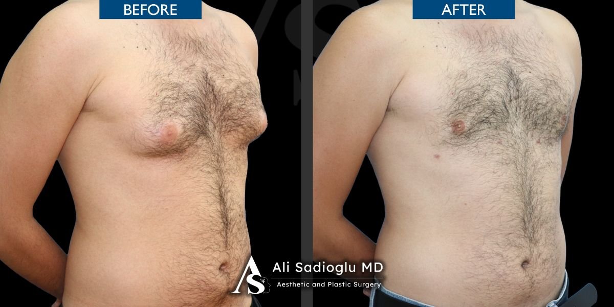 نتائج قبل وبعد جراحة التثدي في عيادة د. صفا مناف، تحديد صدر الرجل