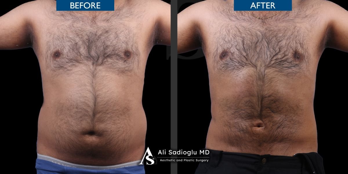 نتائج شفط الدهون 360 قبل وبعد في عيادة Dr. Safa Manav، تحسين شكل الجسم
