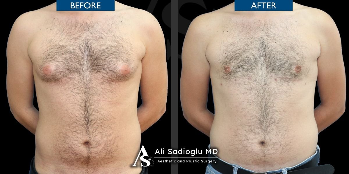 نتائج شفط الدهون 360 قبل وبعد في عيادة Dr. Safa Manav، تحسين شكل الجسم للرجال