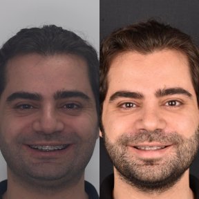 Jaw Shaping with Custom Implants - photo 5