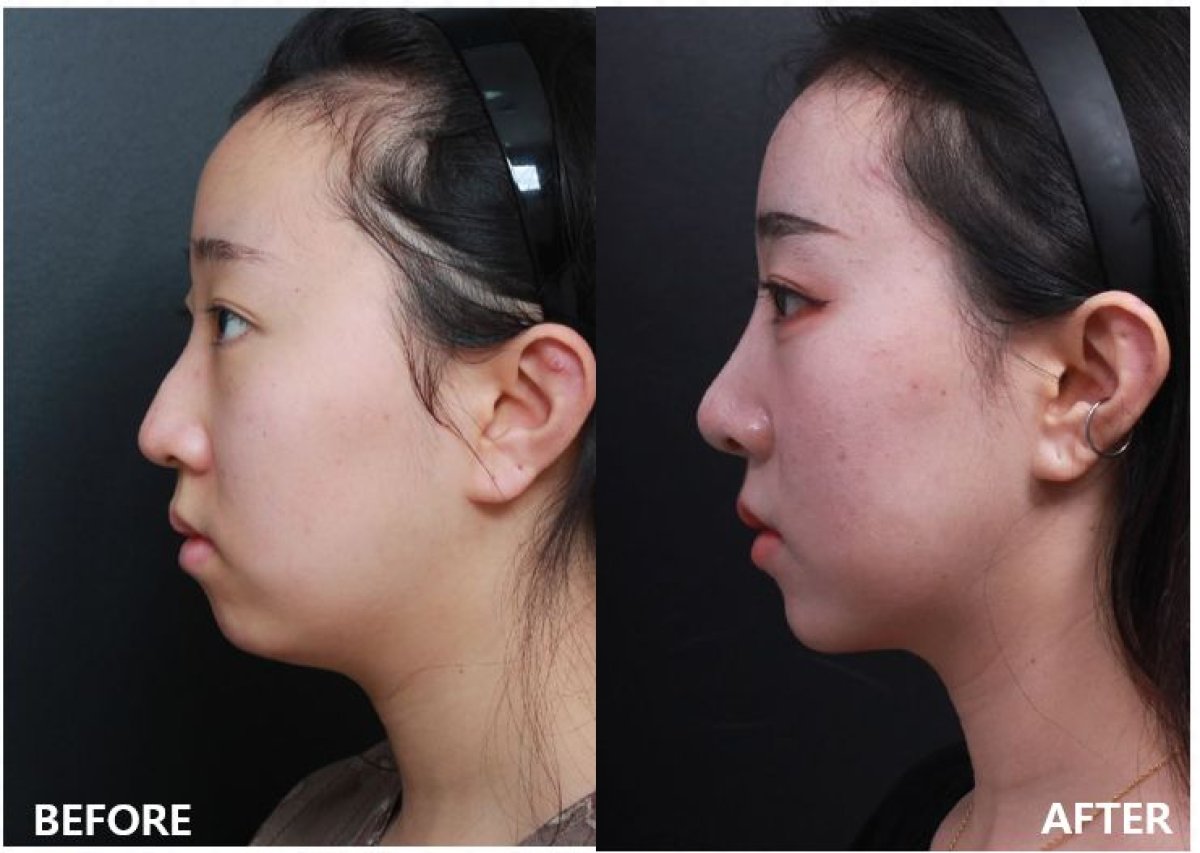 Before and after chin implant results at VG Plastic Surgery, enhanced chin profile and contour