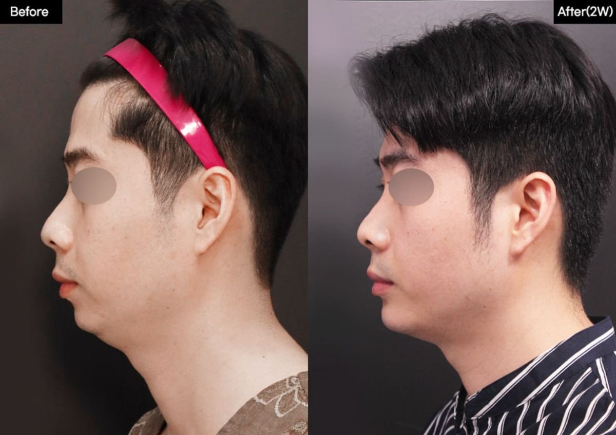 Before and after chin implant results at VG Plastic Surgery, improved chin contour visible