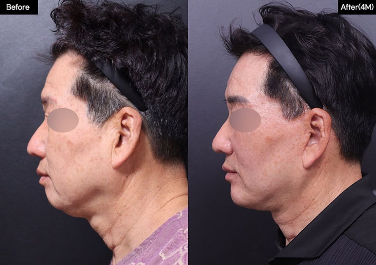Resultados antes y después de implante de mentón en VG Plastic Surgery, mejor contorno facial