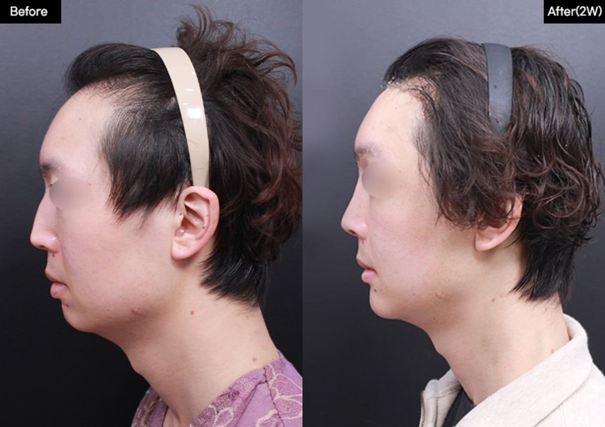 Before and after chin implant results at VG Plastic Surgery – improved chin contour and profile