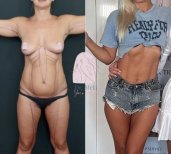 Before and after Липосакция photos by Dr. Muhammet Mustafa Aydinol