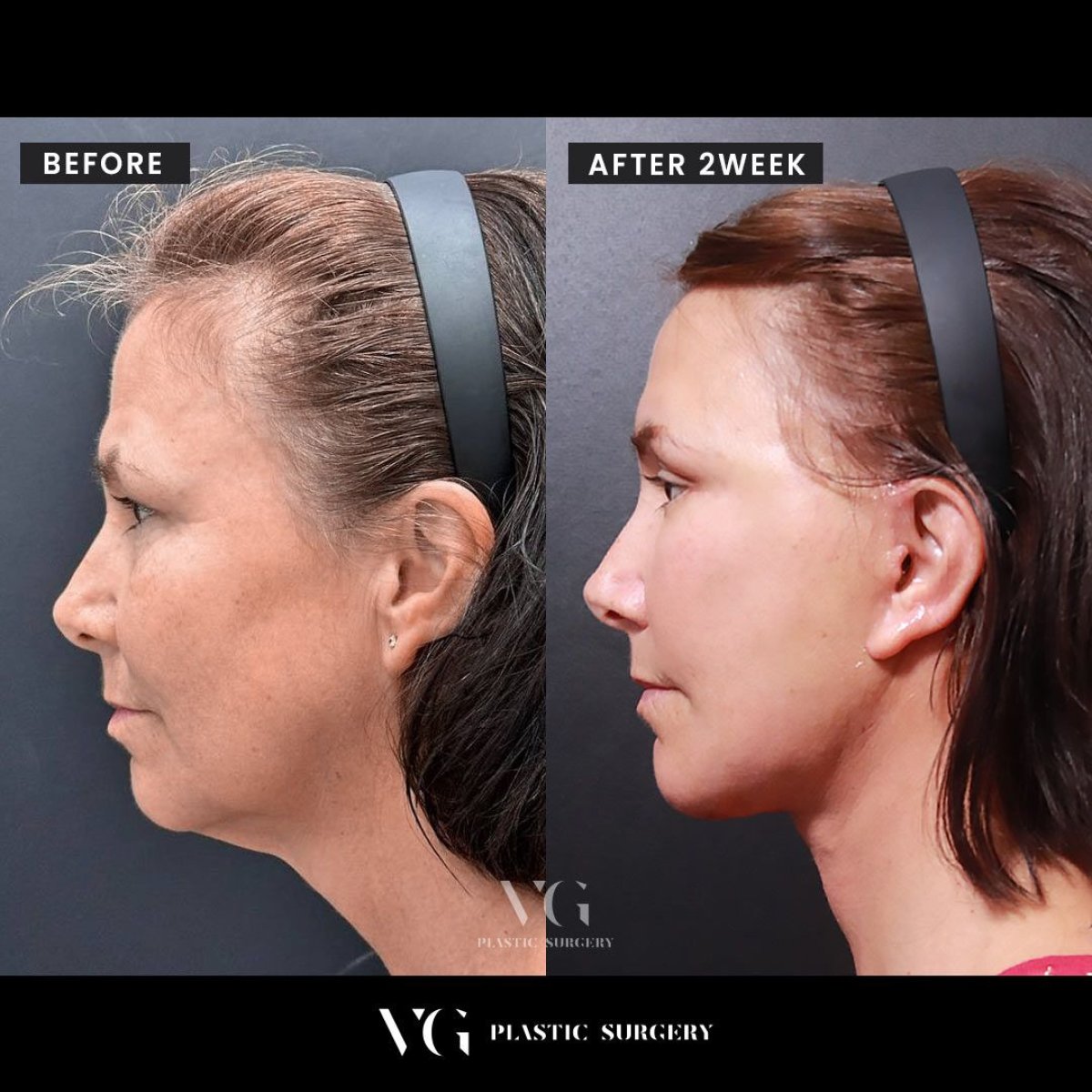 Результаты мини-подтяжки лица до и после в VG Plastic Surgery – омоложение лица