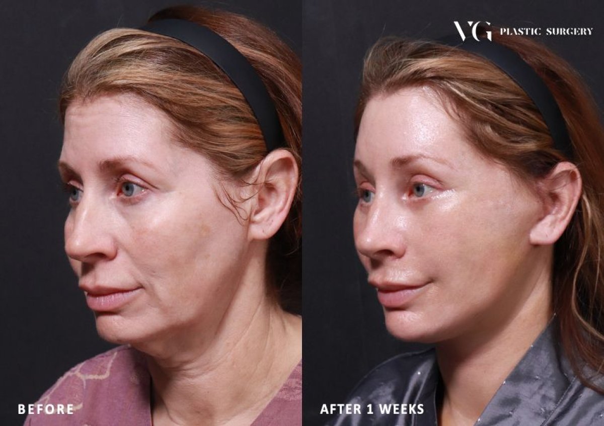 Resultados de minilifting facial antes y después en VG Plastic Surgery – rejuvenecimiento visible