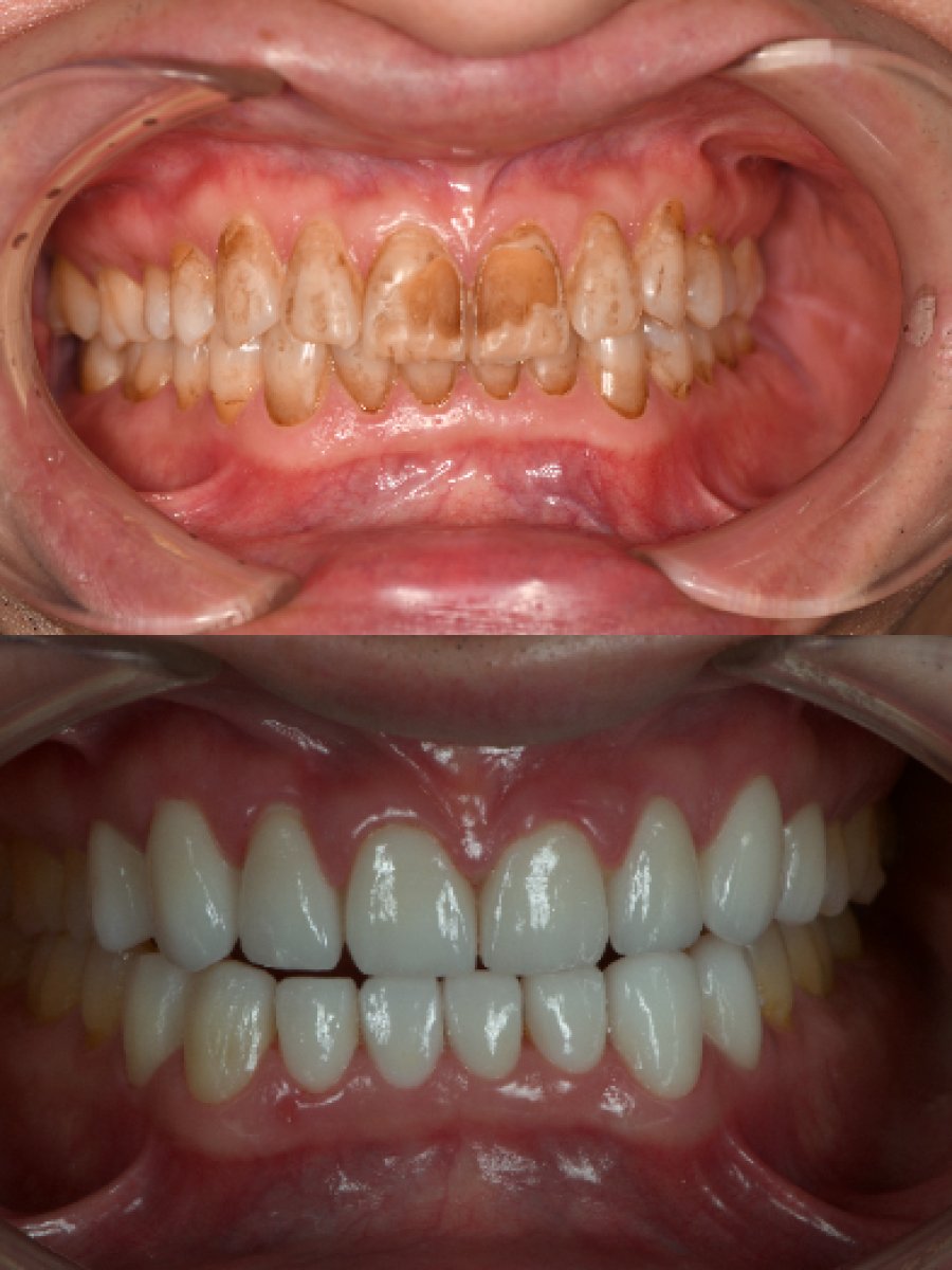 Результаты до и после установки фарфоровых виниров в Kitcha Dental Clinic, преображение улыбки