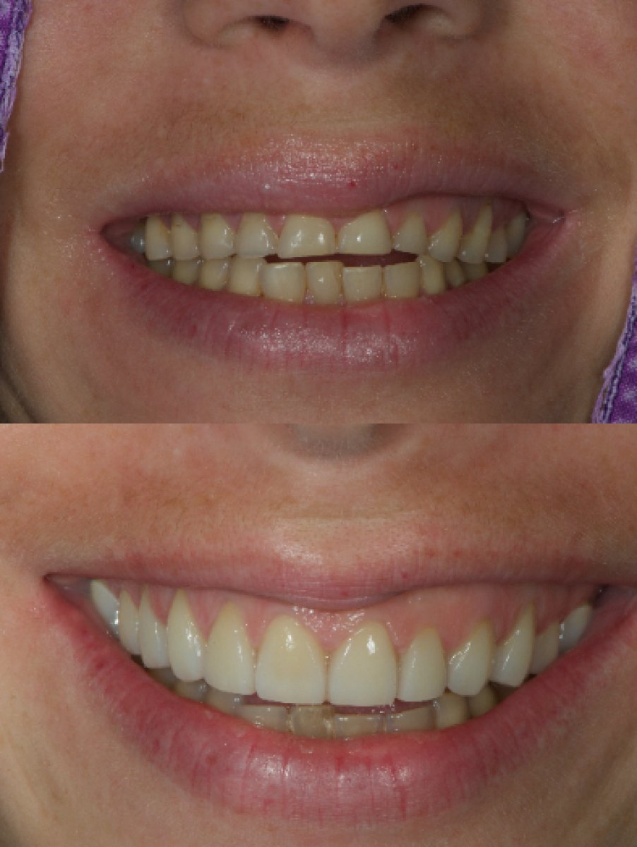 Результаты до и после установки виниров в Kitcha Dental Clinic – улучшение улыбки