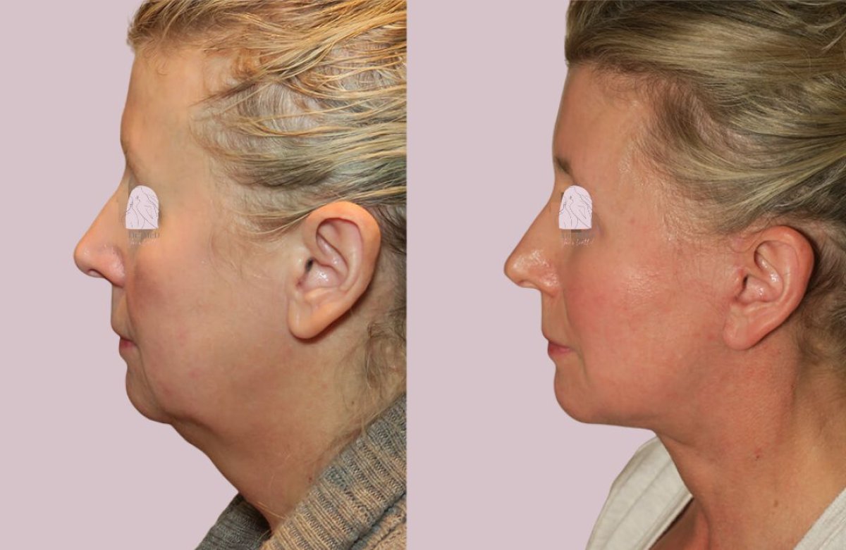 Before and after facelift results at Dr. MED – visible facial rejuvenation and tighter jawline