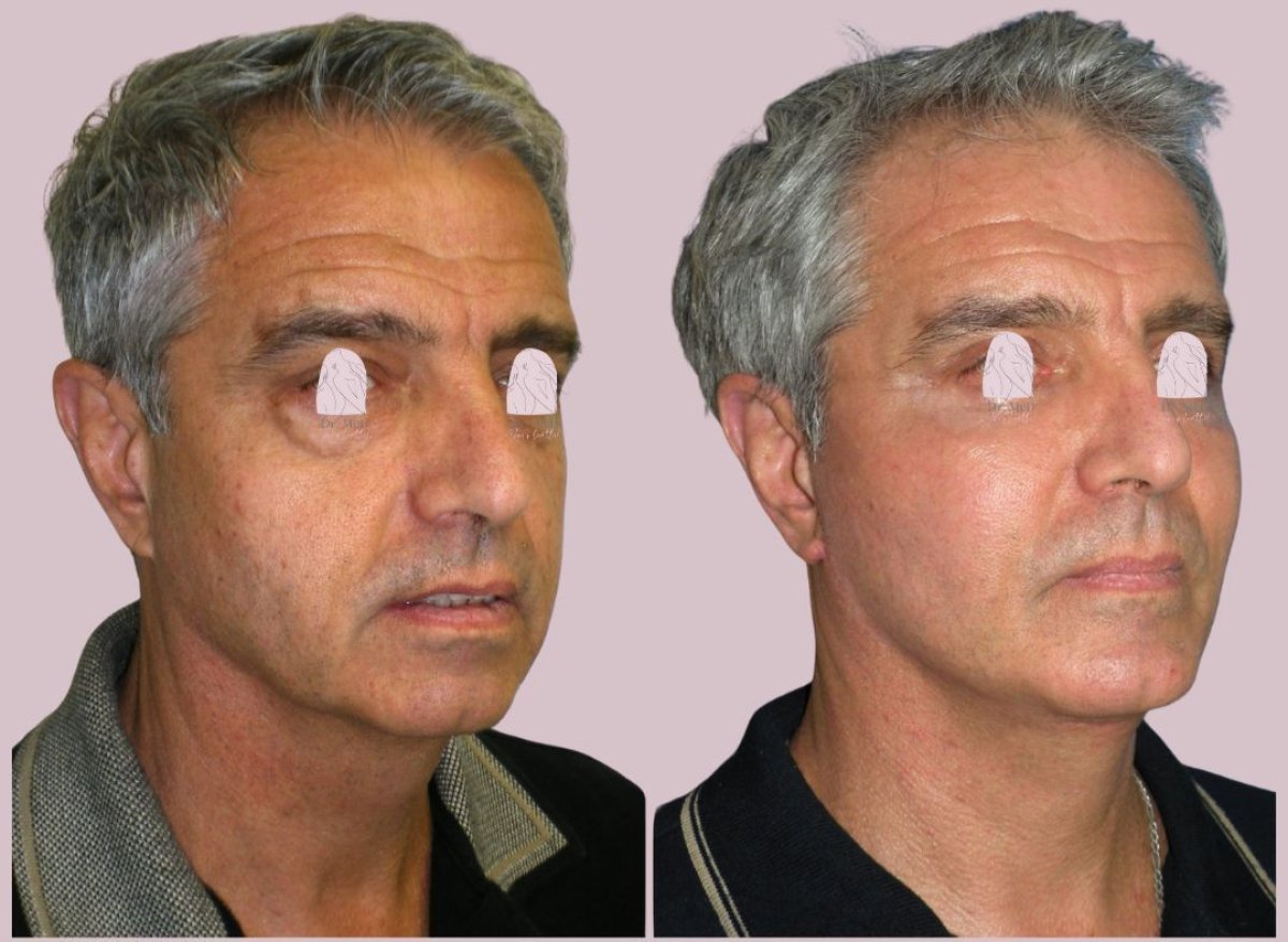 Resultados de lifting facial antes y después en Dr. MED – rejuvenecimiento y piel más firme