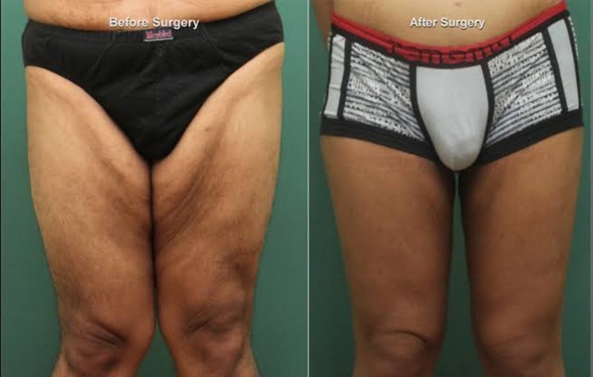 Before and after thigh lift results at ID Clinic Bangkok, improved thigh contour and firmness